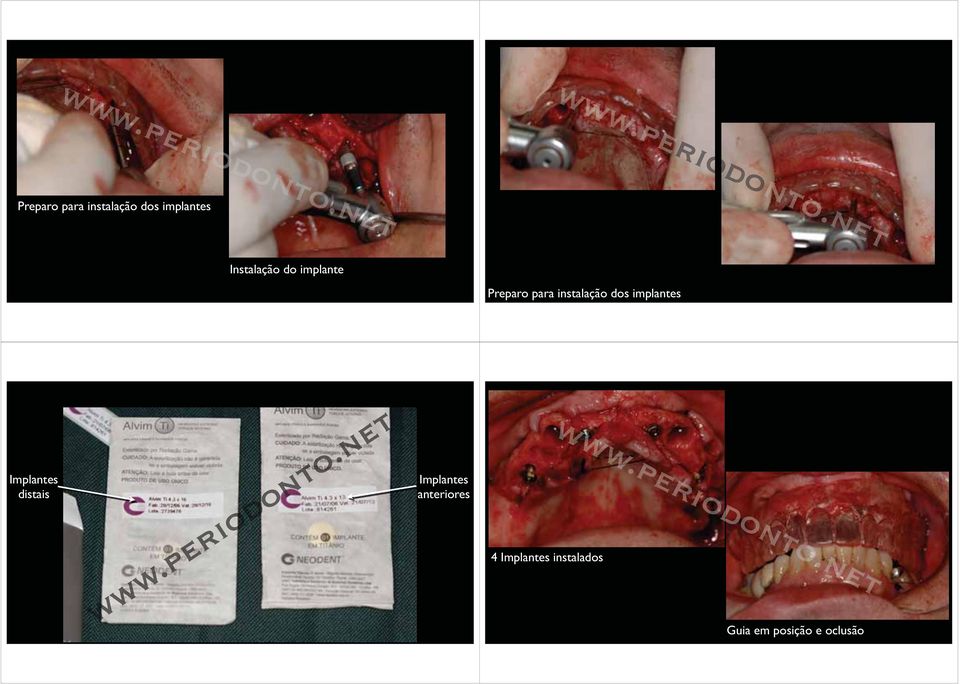 dos implantes Implantes distais Implantes