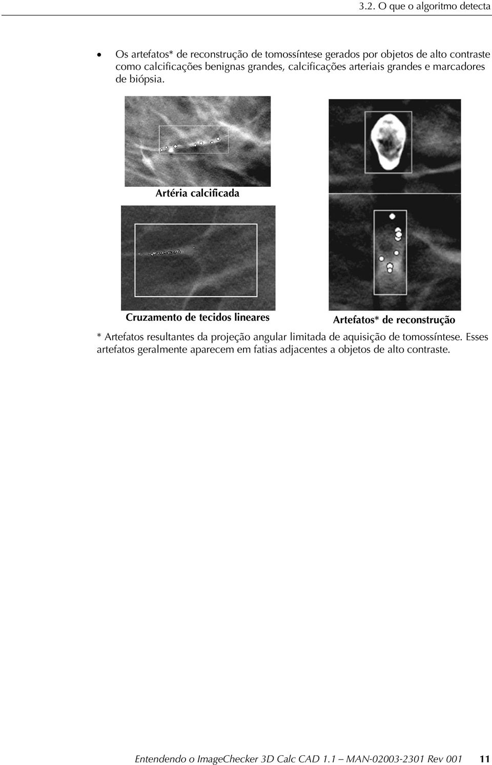 Artéria calcificada Cruzamento de tecidos lineares Artefatos* de reconstrução * Artefatos resultantes da projeção angular limitada