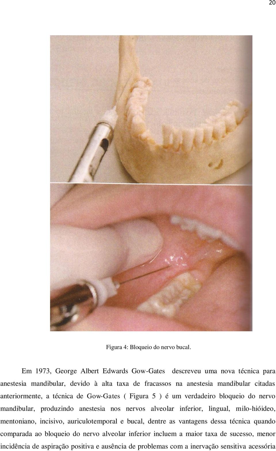 anteriormente, a técnica de Gow-Gates ( Figura 5 ) é um verdadeiro bloqueio do nervo mandibular, produzindo anestesia nos nervos alveolar inferior, lingual,