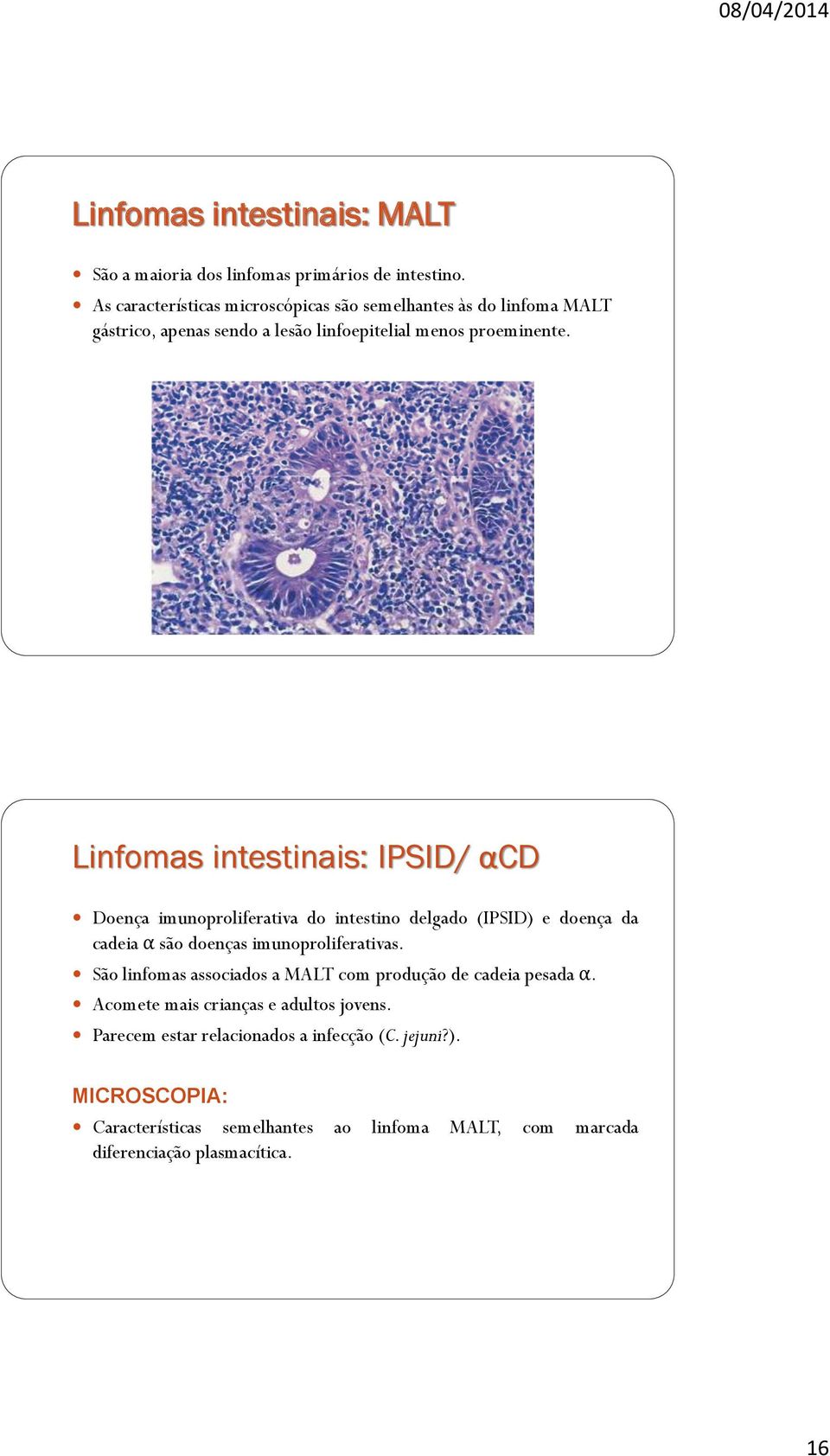 Linfomas intestinais: IPSID/ αcd Doença imunoproliferativa do intestino delgado (IPSID) e doença da cadeia α são doenças imunoproliferativas.