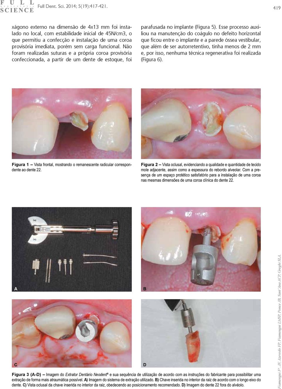 Esse processo auxiliou na manutenção do coágulo no defeito horizontal que ficou entre o implante e a parede óssea vestibular, que além de ser autorretentivo, tinha menos de 2 mm e, por isso, nenhuma