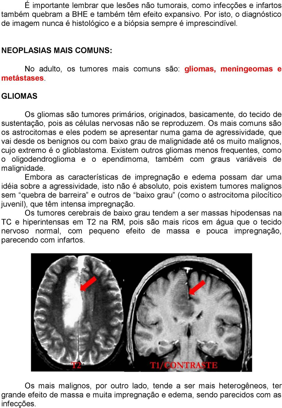 GLIOMAS Os gliomas são tumores primários, originados, basicamente, do tecido de sustentação, pois as células nervosas não se reproduzem.