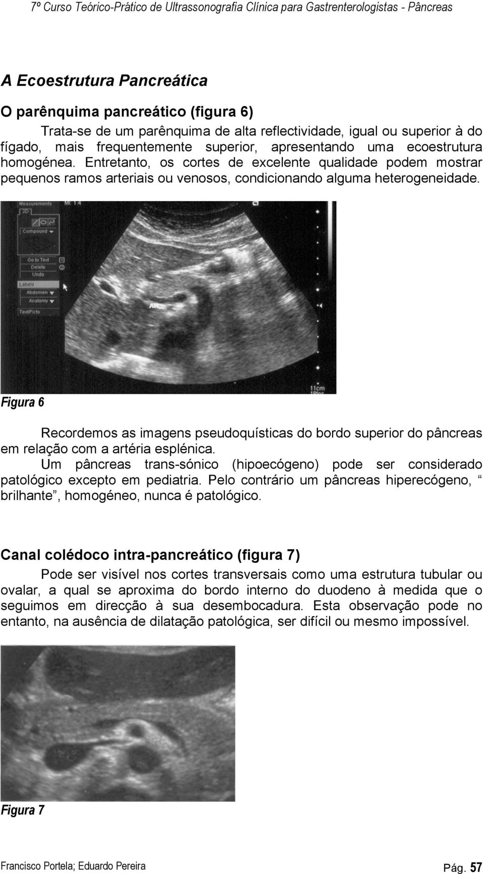 Figura 6 Recordemos as imagens pseudoquísticas do bordo superior do pâncreas em relação com a artéria esplénica.