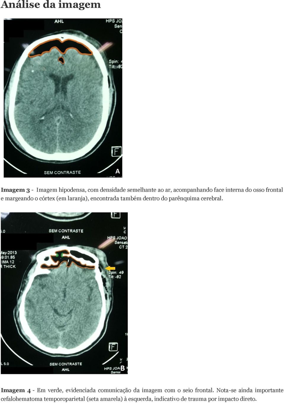 cerebral. Imagem 4 - Em verde, evidenciada comunicação da imagem com o seio frontal.