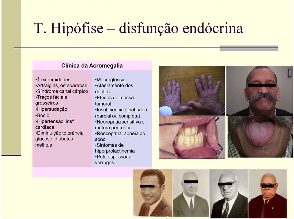 mellitus Macroglossia Afastamento dos dentes Efeitos de massa tumoral Insuficiência hipofisária (parcial ou completa)