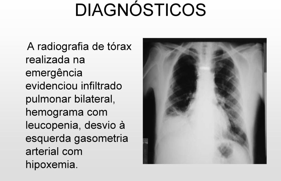 infiltrado pulmonar bilateral, hemograma com