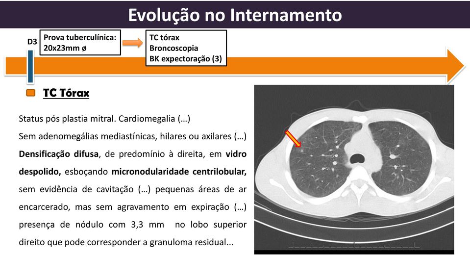 Cardiomegalia ( ) Sem adenomegálias mediastínicas, hilares ou axilares ( ) Densificação difusa, de predomínio à direita, em vidro