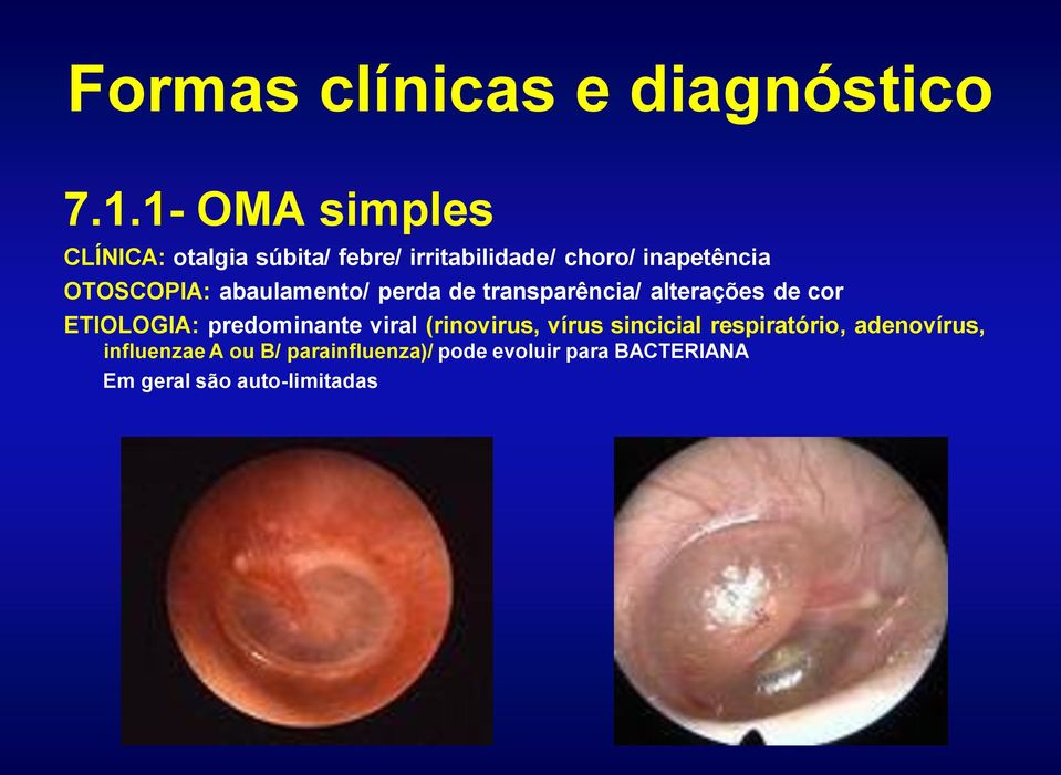 OTOSCOPIA: abaulamento/ perda de transparência/ alterações de cor ETIOLOGIA: predominante