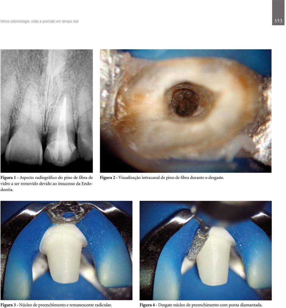 Figura 2 - Visualização intracanal de pino de fibra durante o desgaste.