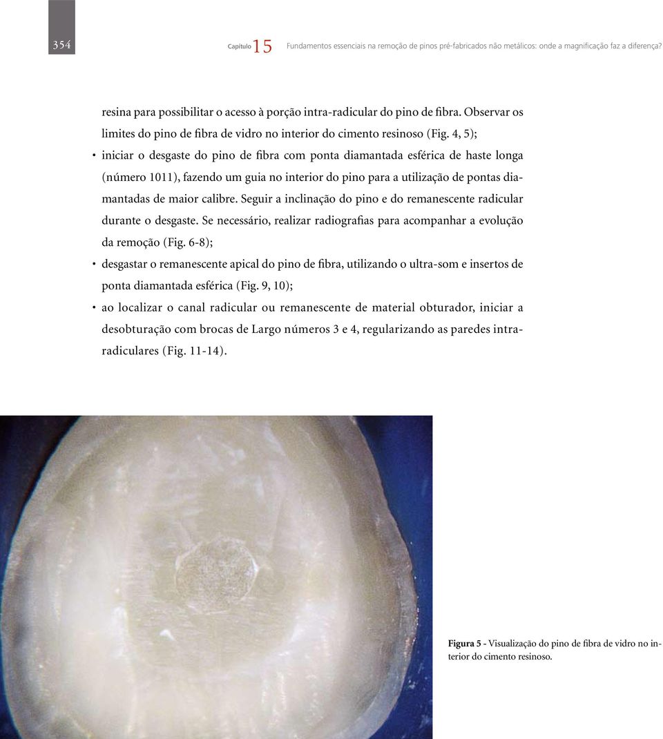 4, 5); iniciar o desgaste do pino de fibra com ponta diamantada esférica de haste longa (número 1011), fazendo um guia no interior do pino para a utilização de pontas diamantadas de maior calibre.