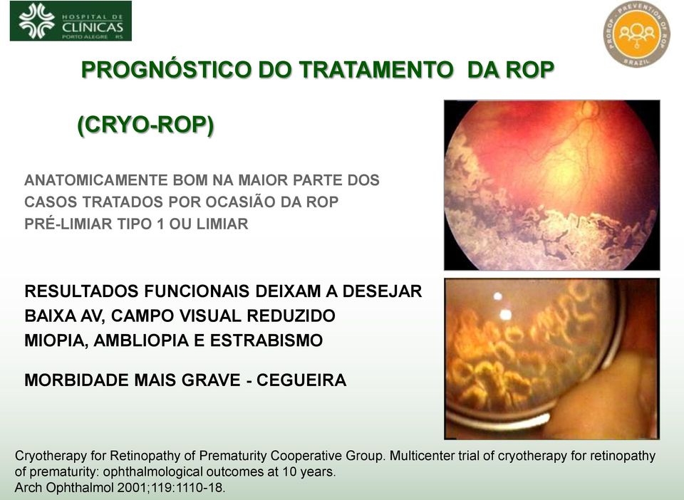 ESTRABISMO MORBIDADE MAIS GRAVE - CEGUEIRA Cryotherapy for Retinopathy of Prematurity Cooperative Group.