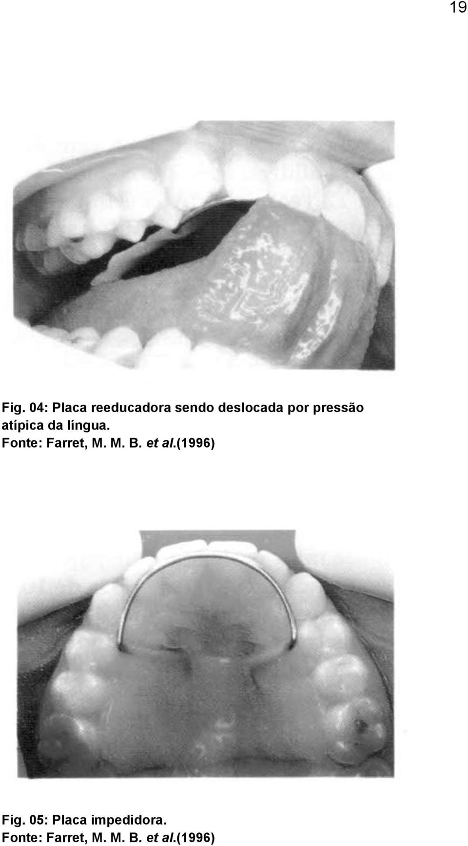 pressão atípica da língua. Fonte: Farret, M.