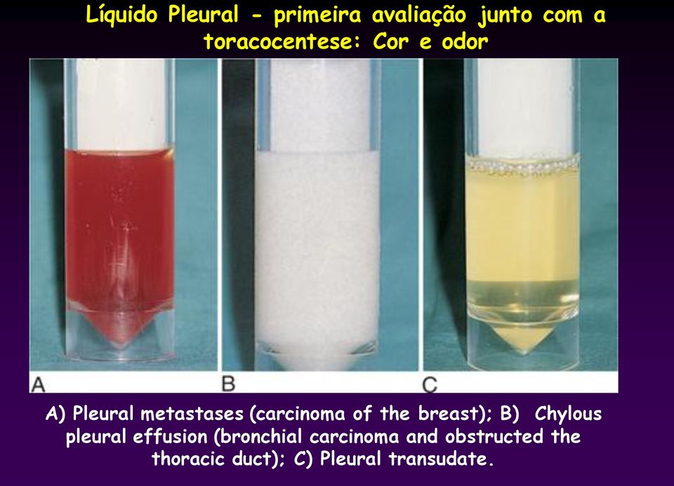 (carcinoma of the breast); B) Chylous pleural effusion