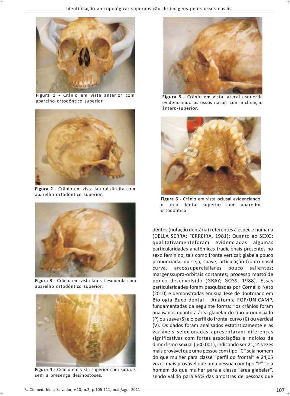 Figura 3 - Crânio em vista lateral esquerda com aparelho ortodôntico superior. Figura 4 - Crânio em vista superior com suturas sem a presença desinostoses.