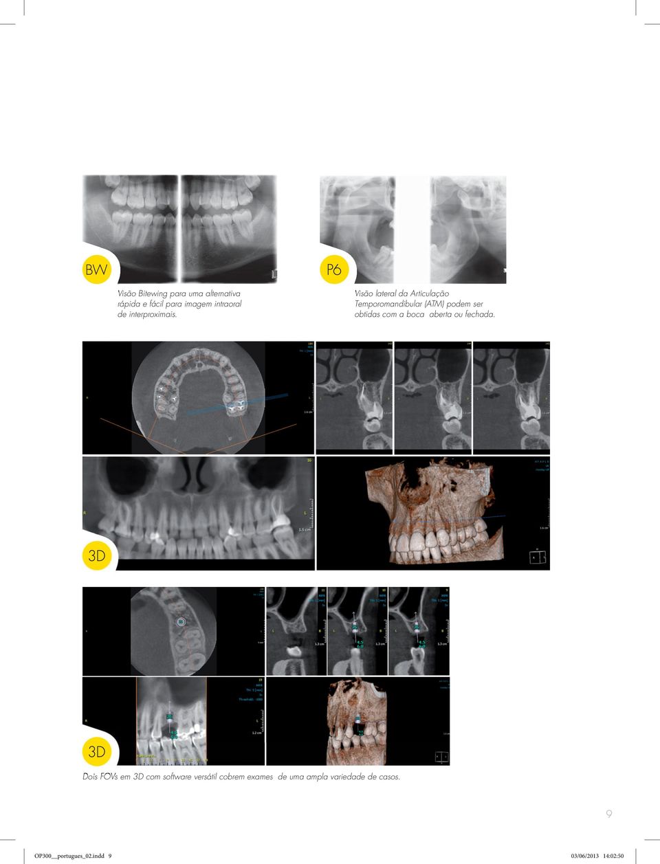 Visão lateral da Articulação Temporomandibular (ATM) podem ser obtidas com a boca