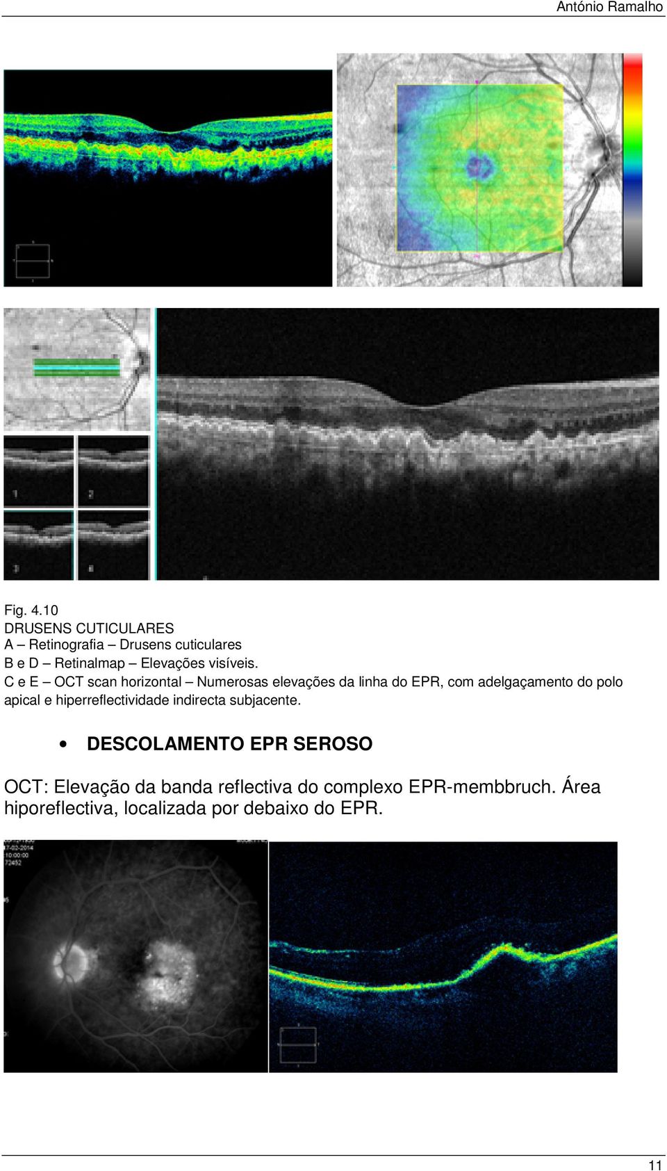 C e E OCT scan horizontal Numerosas elevações da linha do EPR, com adelgaçamento do polo apical