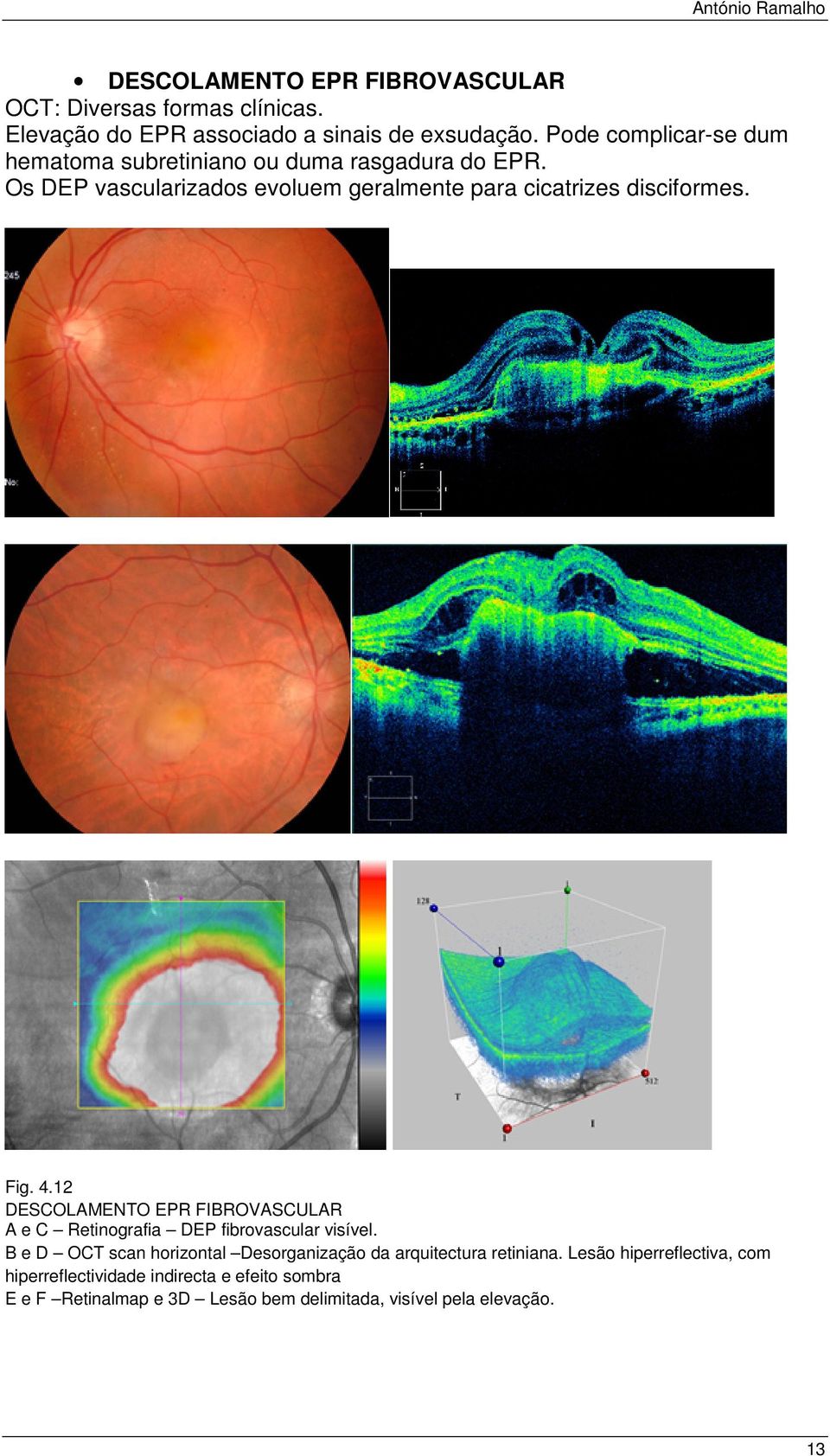 Os DEP vascularizados evoluem geralmente para cicatrizes disciformes. Fig. 4.