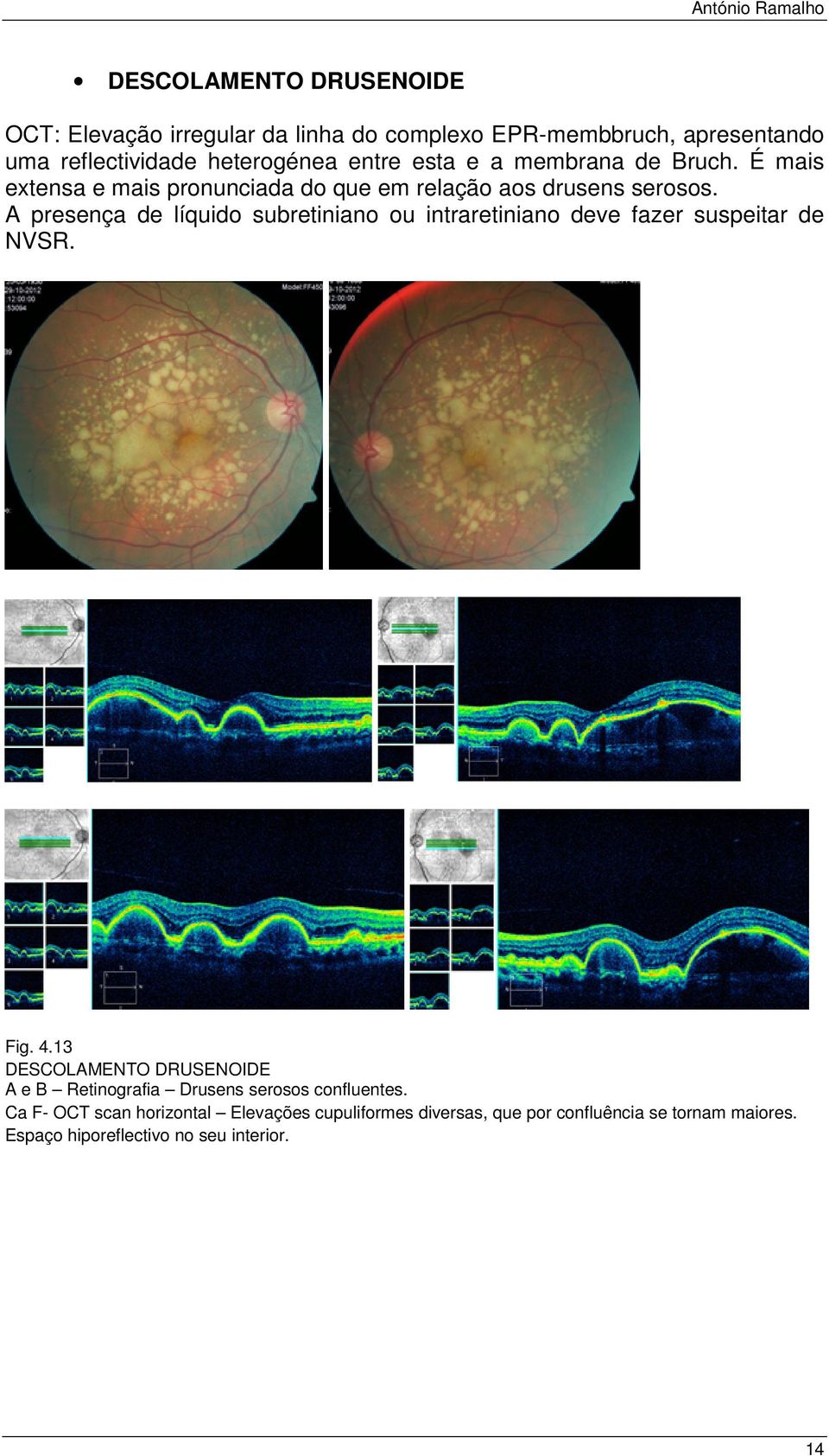 A presença de líquido subretiniano ou intraretiniano deve fazer suspeitar de NVSR. Fig. 4.