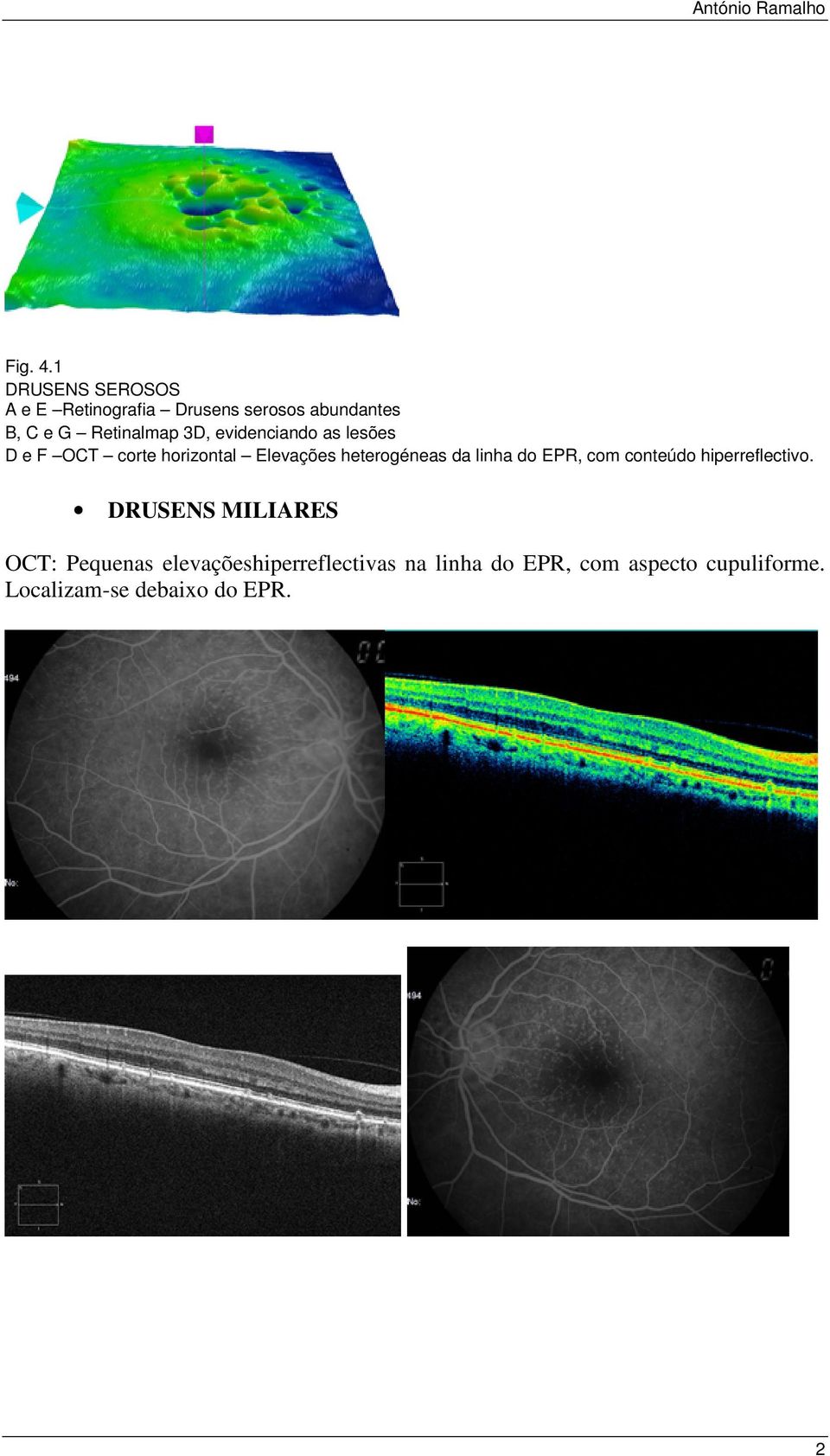 3D, evidenciando as lesões D e F OCT corte horizontal Elevações heterogéneas da linha