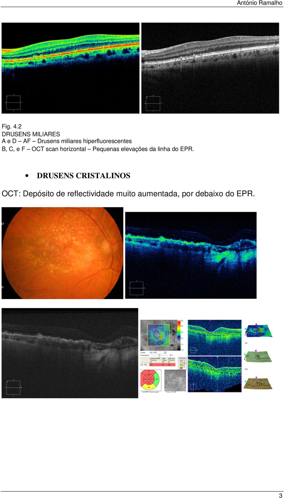 hiperfluorescentes B, C, e F OCT scan horizontal