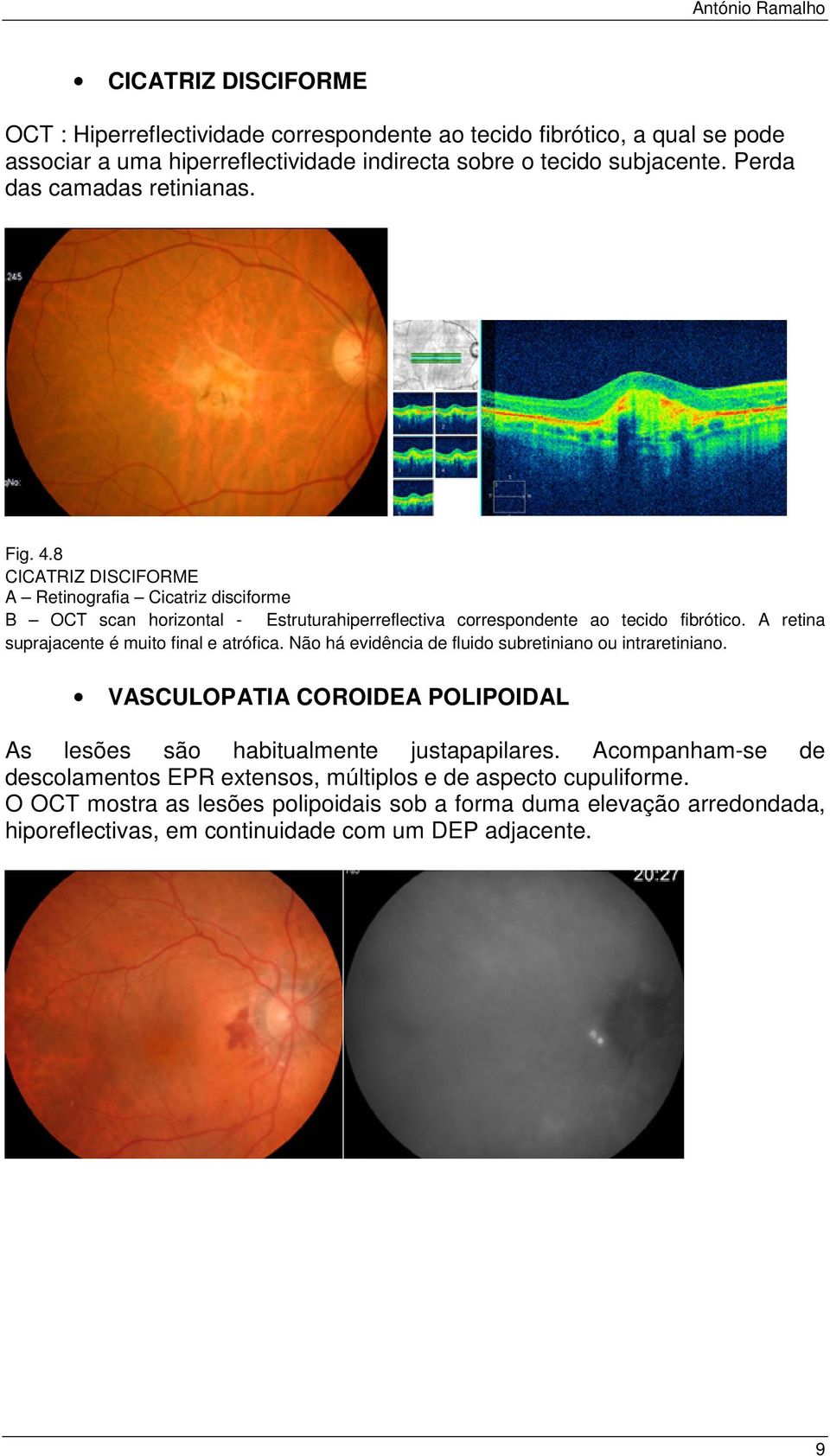 A retina suprajacente é muito final e atrófica. Não há evidência de fluido subretiniano ou intraretiniano. VASCULOPATIA COROIDEA POLIPOIDAL As lesões são habitualmente justapapilares.