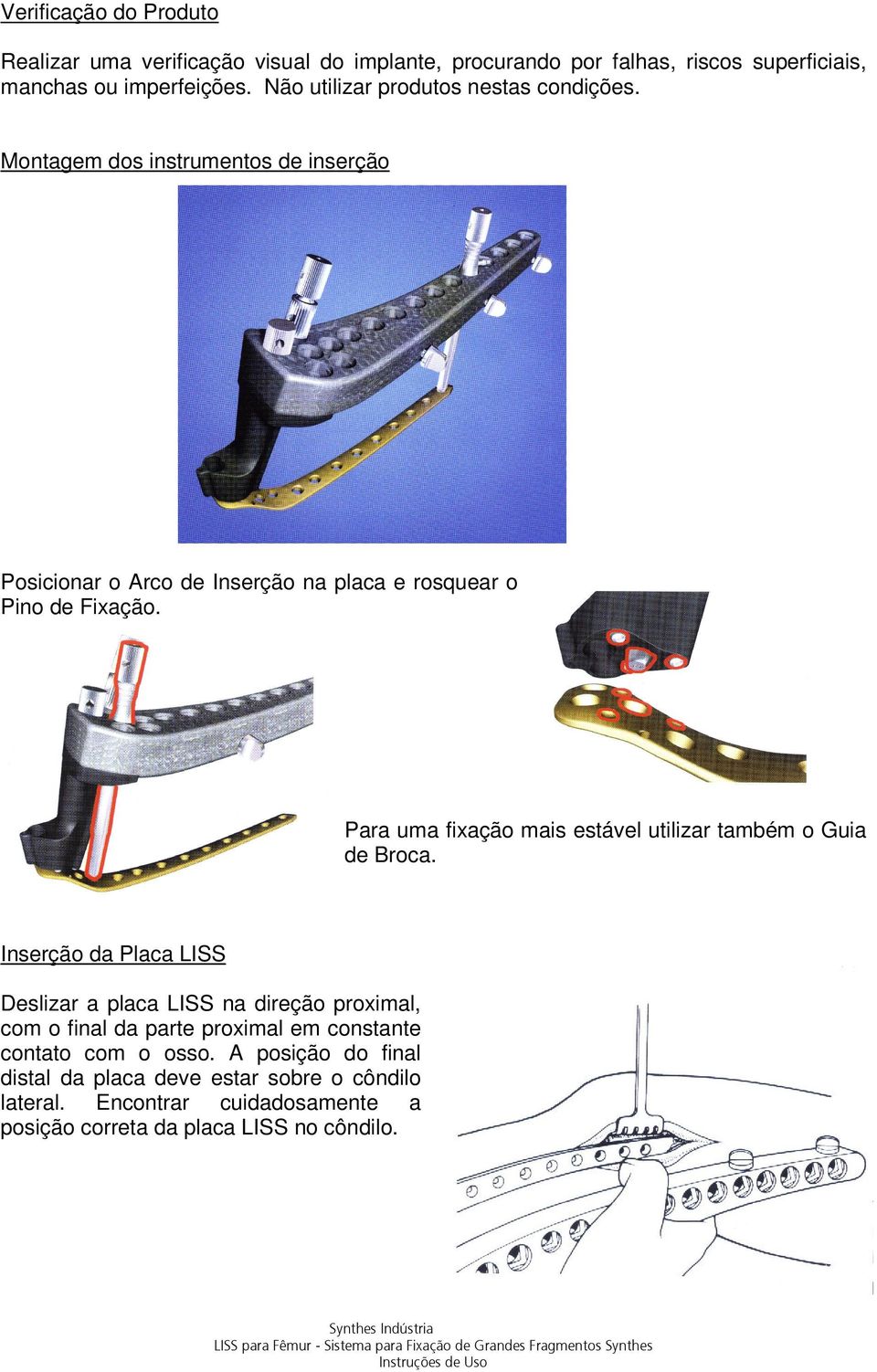 Para uma fixação mais estável utilizar também o Guia de Broca.