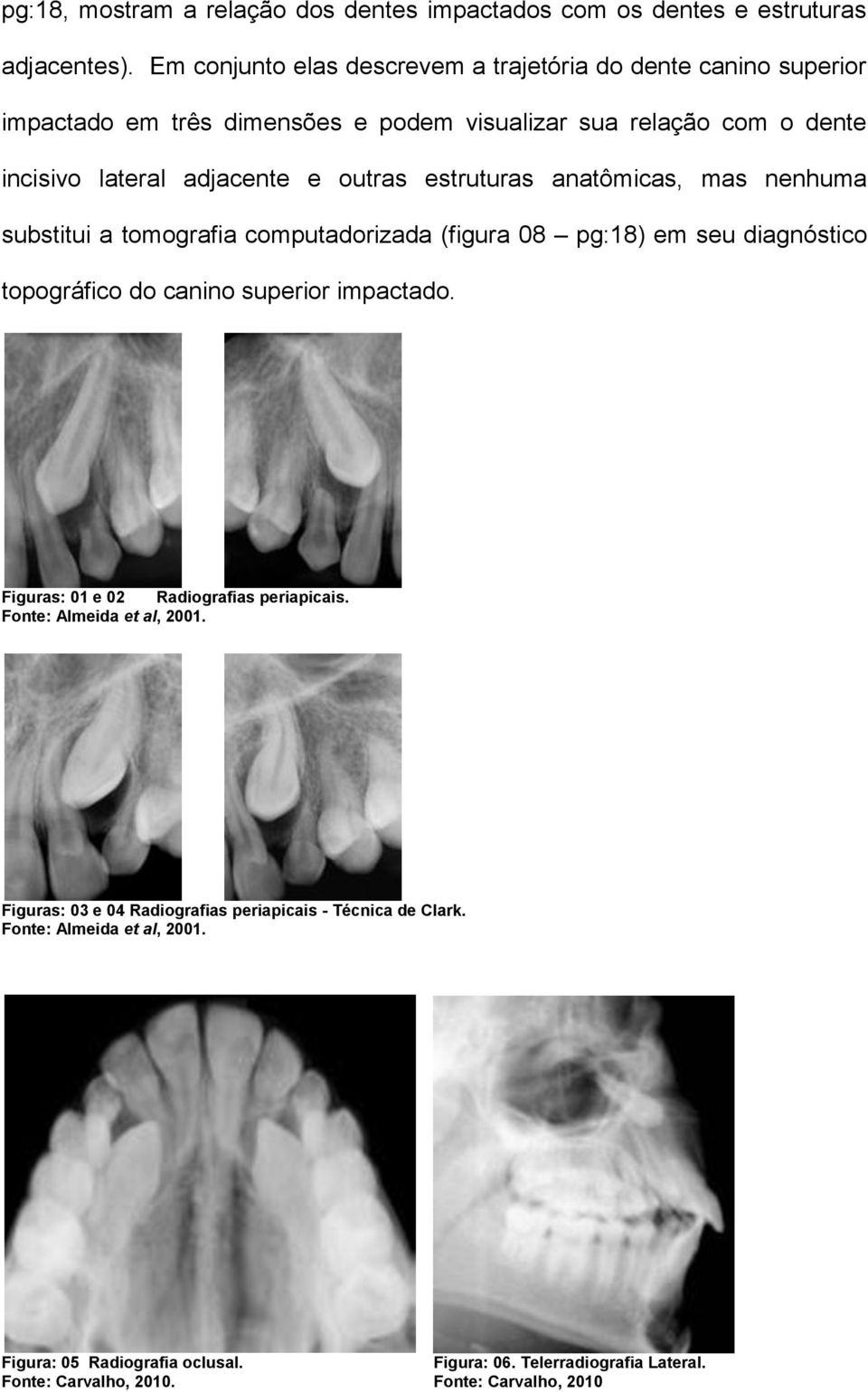 estruturas anatômicas, mas nenhuma substitui a tomografia computadorizada (figura 08 pg:18) em seu diagnóstico topográfico do canino superior impactado.