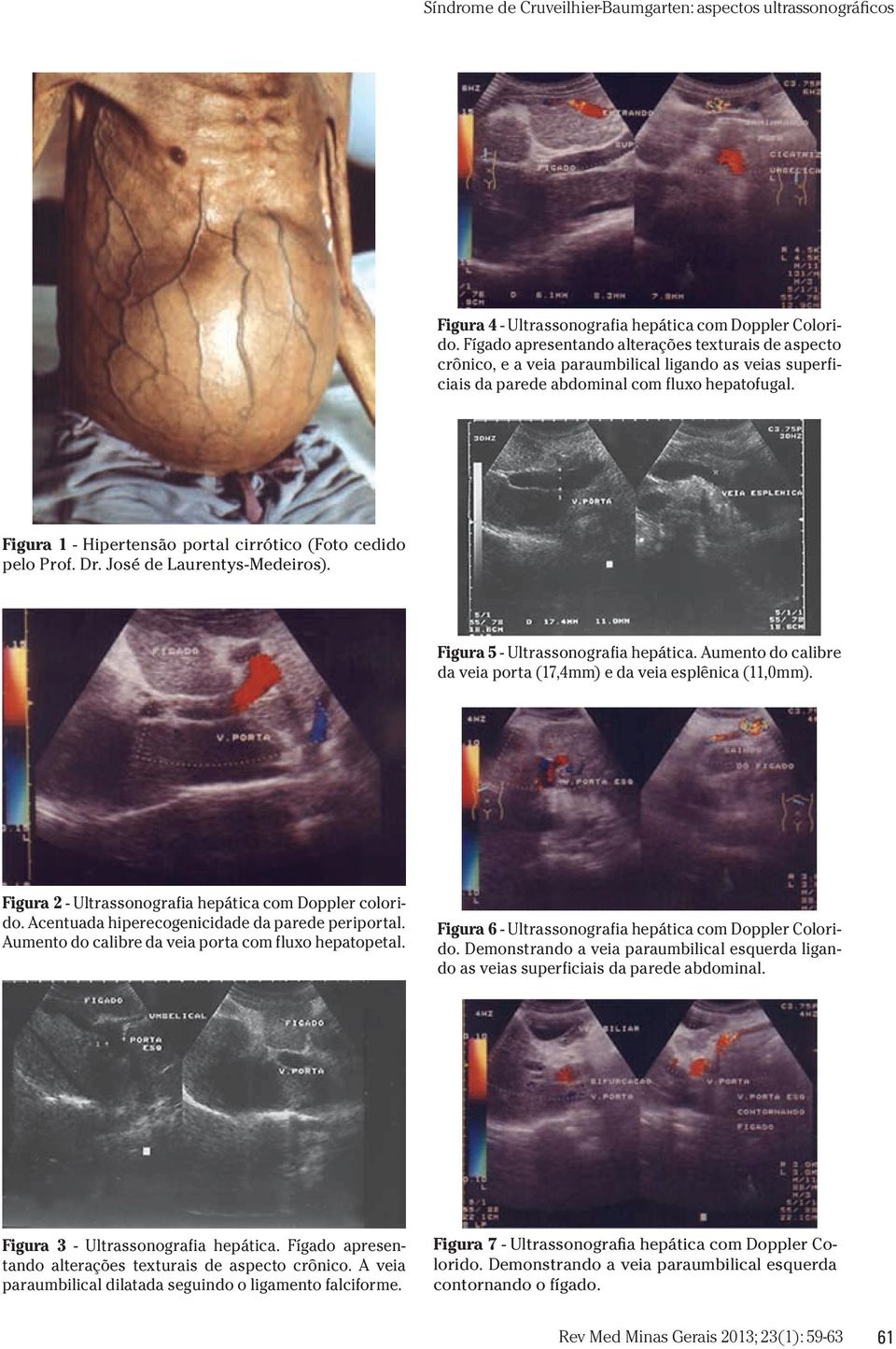 Figura 1 - Hipertensão portal cirrótico (Foto cedido pelo Prof. Dr. José de Laurentys-Medeiros). Figura 5 - Ultrassonografia hepática.