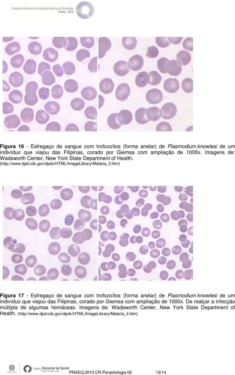 htm) Figura 17 - Esfregaço de sangue com trofozoítos (forma anelar) de Plasmodium knowlesi de um indivíduo que viajou das Filipinas, corado por Giemsa com ampliação de