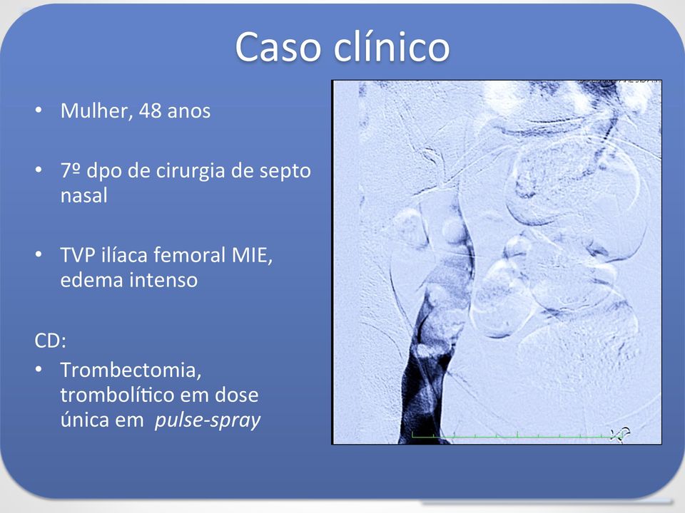 femoral MIE, edema intenso CD: