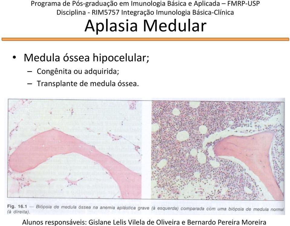 Medular Medula óssea hipocelular;