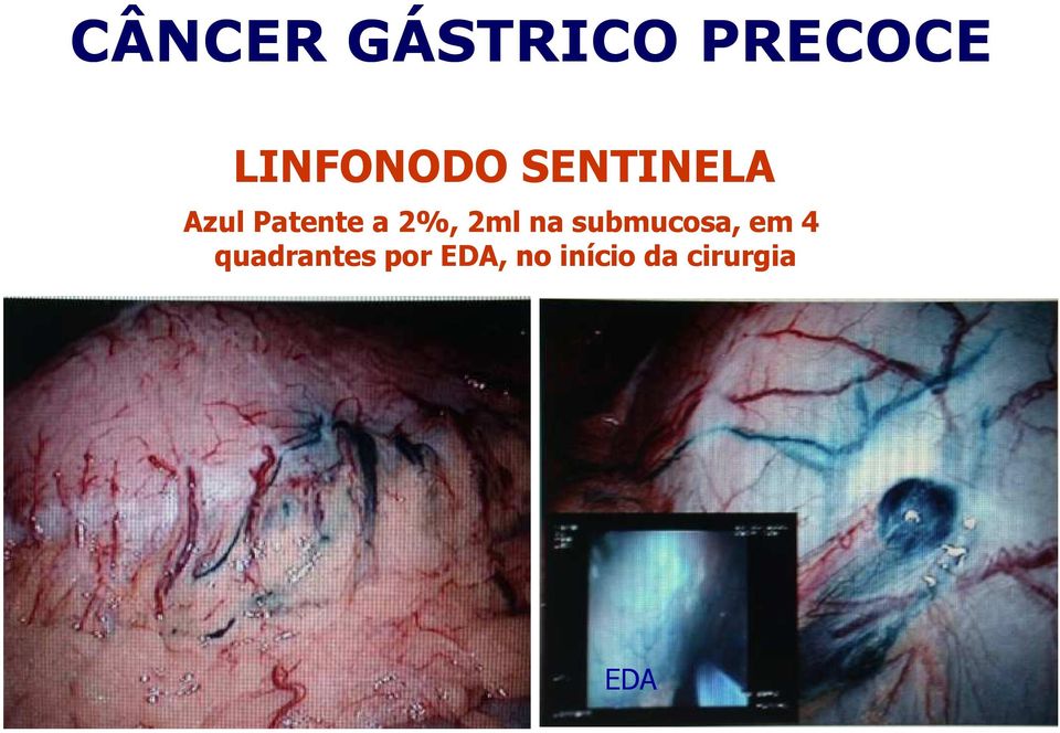 submucosa, em 4 quadrantes