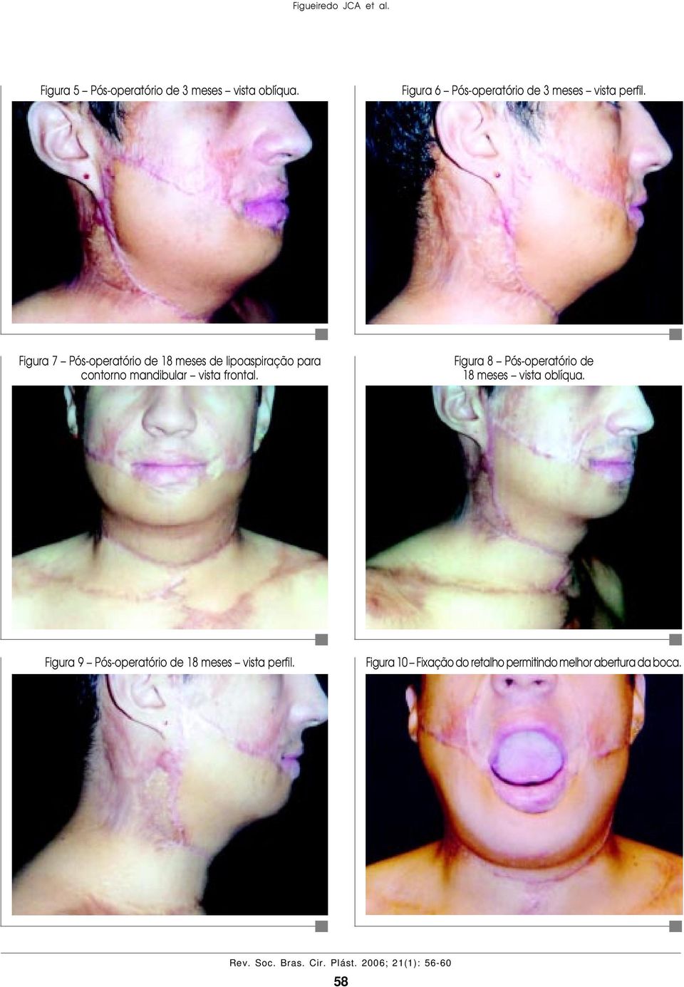 Figura 7 Pós-operatório de 18 meses de lipoaspiração para contorno mandibular vista frontal.