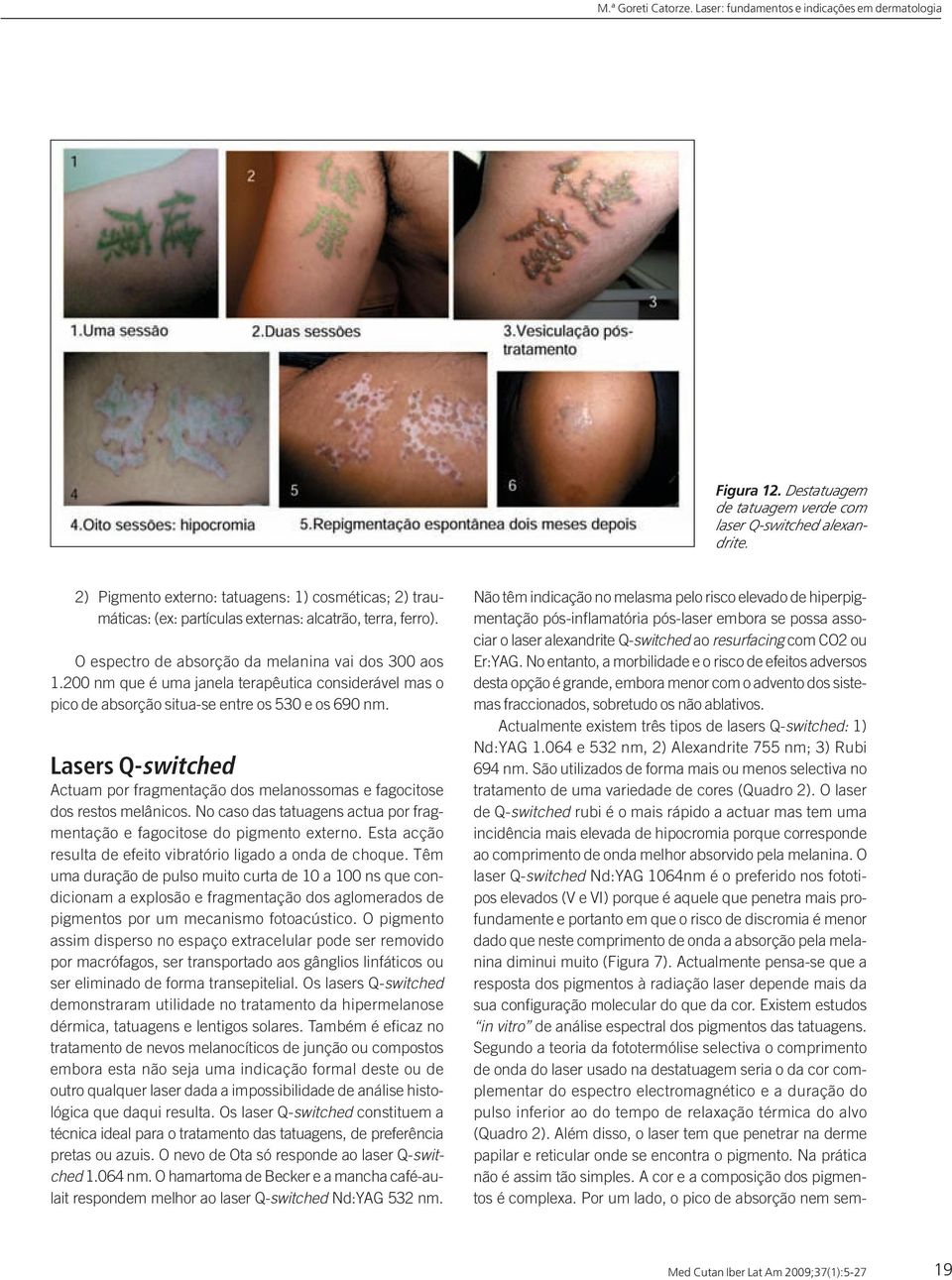 Lasers Q-switched Actuam por fragmentação dos melanossomas e fagocitose dos restos melânicos. No caso das tatuagens actua por fragmentação e fagocitose do pigmento externo.