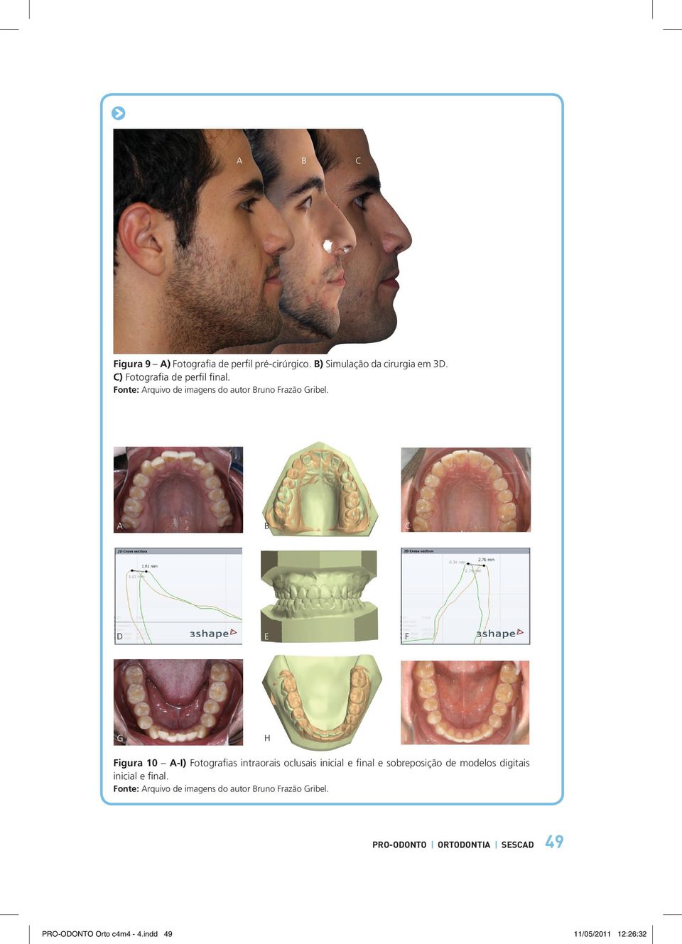 A b c d e f g h i Figura 10 A-I) Fotografias intraorais oclusais inicial e final e sobreposição de modelos
