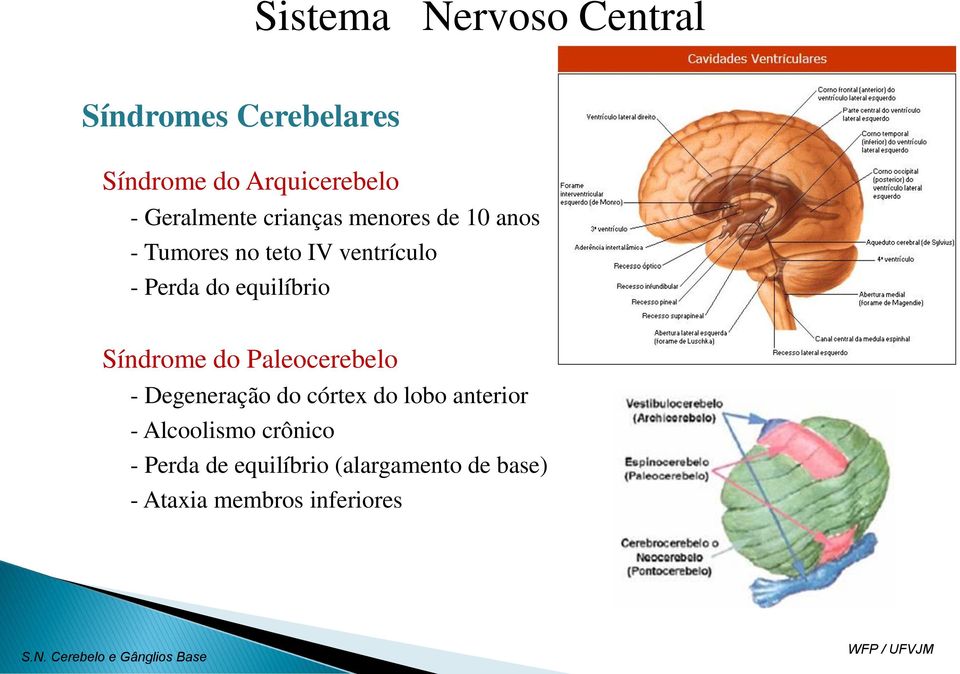 Síndrome do Paleocerebelo - Degeneração do córtex do lobo anterior - Alcoolismo crônico