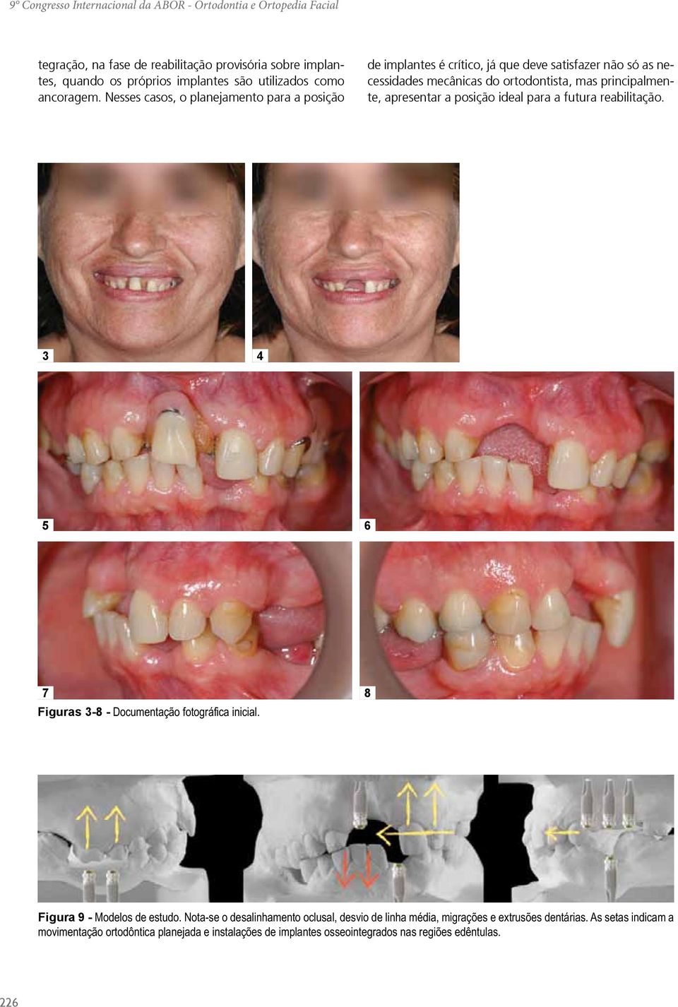 Nesses casos, o planejamento para a posição de implantes é crítico, já que deve satisfazer não só as necessidades mecânicas do ortodontista, mas principalmente, apresentar a