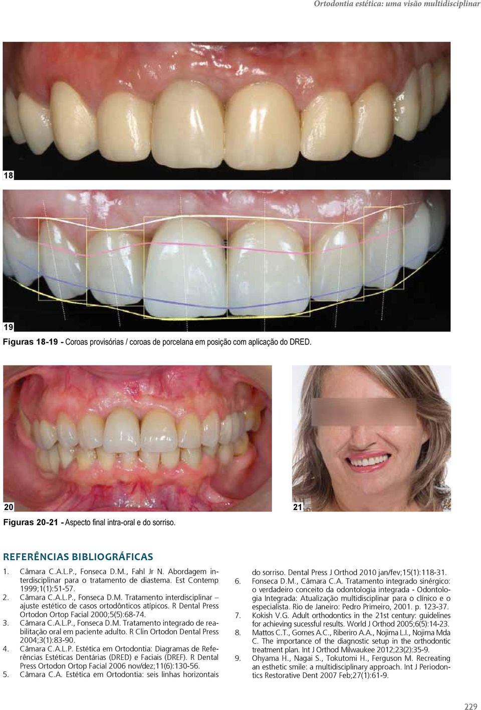 Est Contemp 1999;1(1):51-57. 2. Câmara C.A.L.P., Fonseca D.M. Tratamento interdisciplinar ajuste estético de casos ortodônticos atípicos. R Dental Press Ortodon Ortop Facial 2000;5(5):68-74. 3.