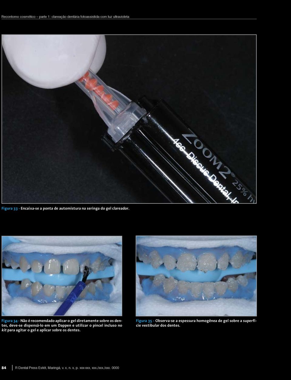 Figura 34 - Não é recomendado aplicar o gel diretamente sobre os dentes, deve-se dispensá-lo em um Dappen e
