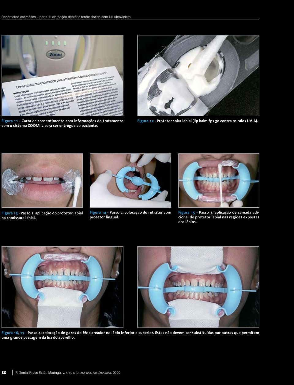 Figura 14 - Passo 2: colocação do retrator com protetor lingual. Figura 15 - Passo 3: aplicação de camada adicional de protetor labial nas regiões expostas dos lábios.