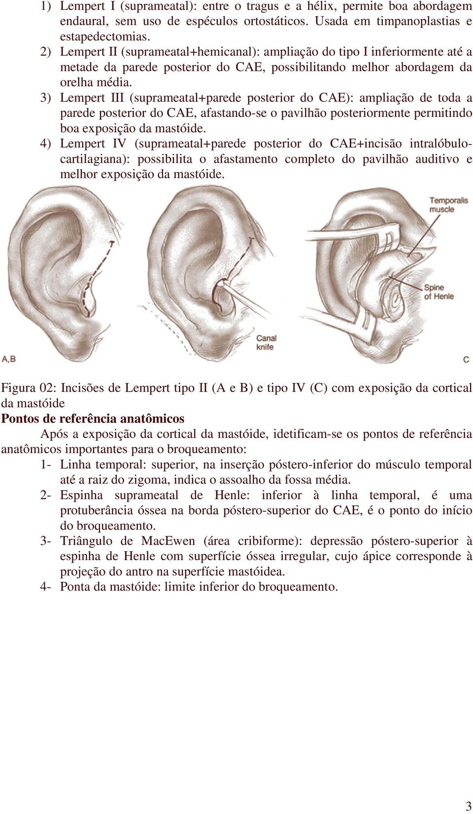 3) Lempert III (suprameatal+parede posterior do CAE): ampliação de toda a parede posterior do CAE, afastando-se o pavilhão posteriormente permitindo boa exposição da mastóide.