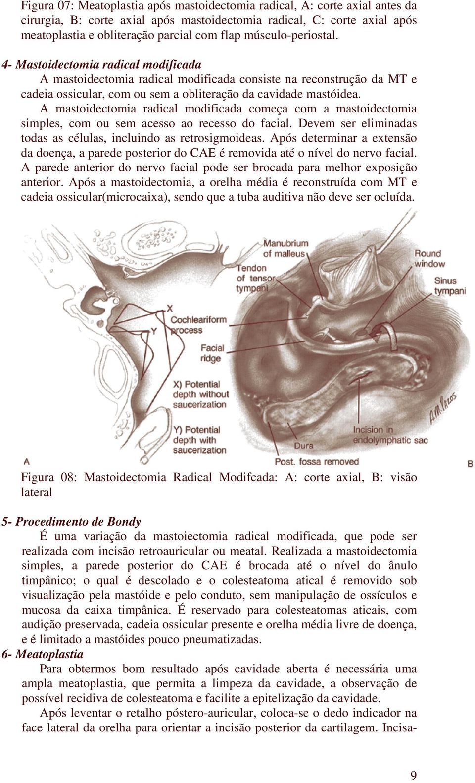 A mastoidectomia radical modificada começa com a mastoidectomia simples, com ou sem acesso ao recesso do facial. Devem ser eliminadas todas as células, incluindo as retrosigmoideas.