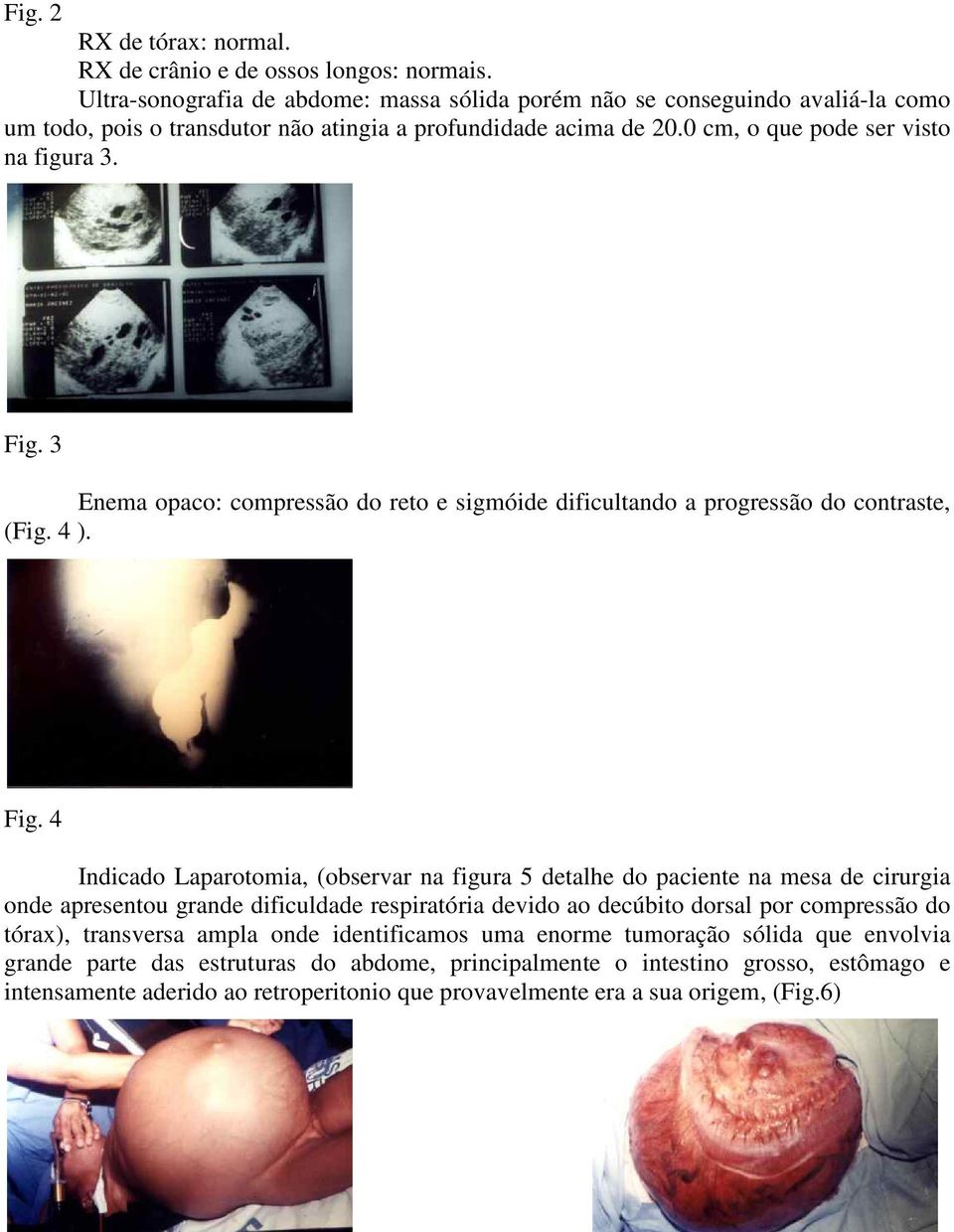 3 Enema opaco: compressão do reto e sigmóide dificultando a progressão do contraste, (Fig. 4 ). Fig.