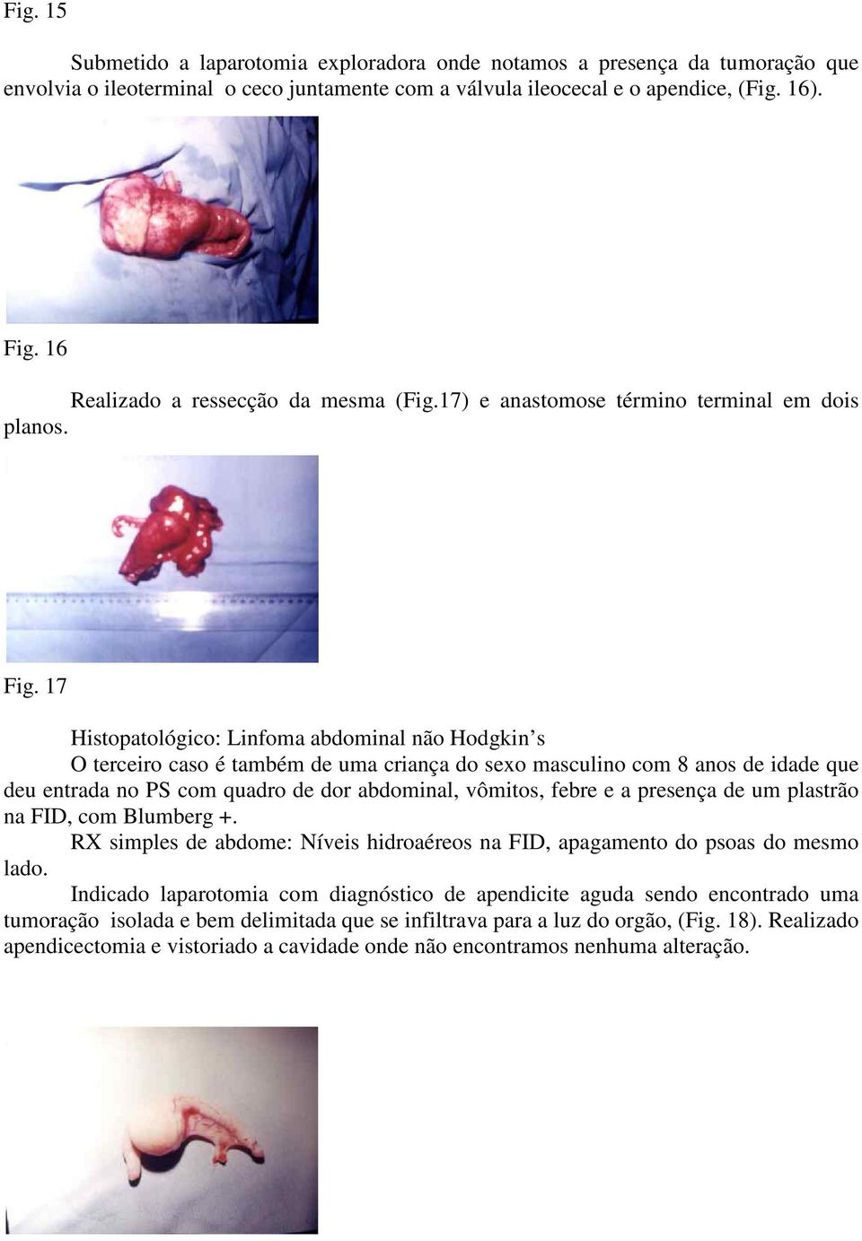 17 Histopatológico: Linfoma abdominal não Hodgkin s O terceiro caso é também de uma criança do sexo masculino com 8 anos de idade que deu entrada no PS com quadro de dor abdominal, vômitos, febre e a