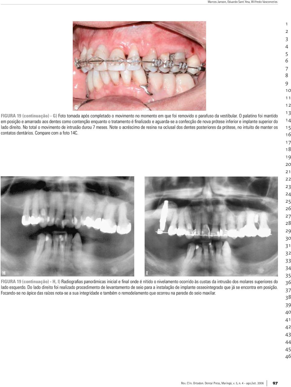 No total o movimento de intrusão durou meses. Note o acréscimo de resina na oclusal dos dentes posteriores da prótese, no intuito de manter os contatos dentários. Compare com a foto C.