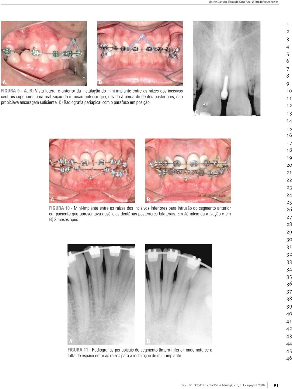 a b figura - Mini-implante entre as raízes dos incisivos inferiores para intrusão do segmento anterior em paciente que apresentava ausências dentárias posteriores bilaterais.