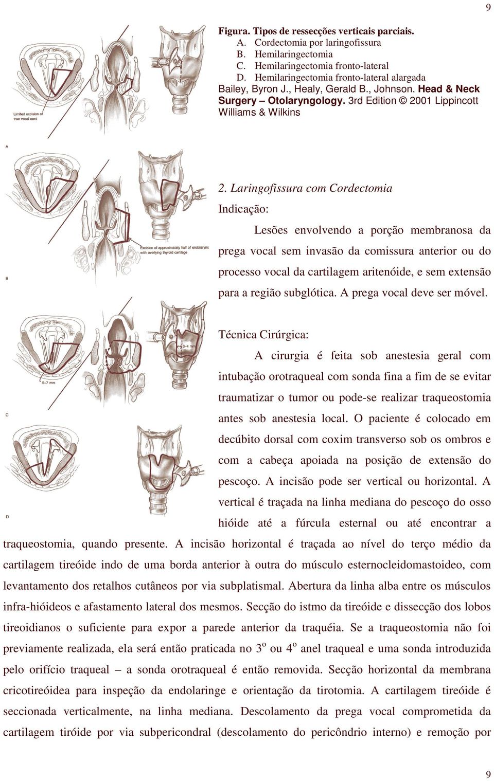 Laringofissura com Cordectomia Indicação: Lesões envolvendo a porção membranosa da prega vocal sem invasão da comissura anterior ou do processo vocal da cartilagem aritenóide, e sem extensão para a
