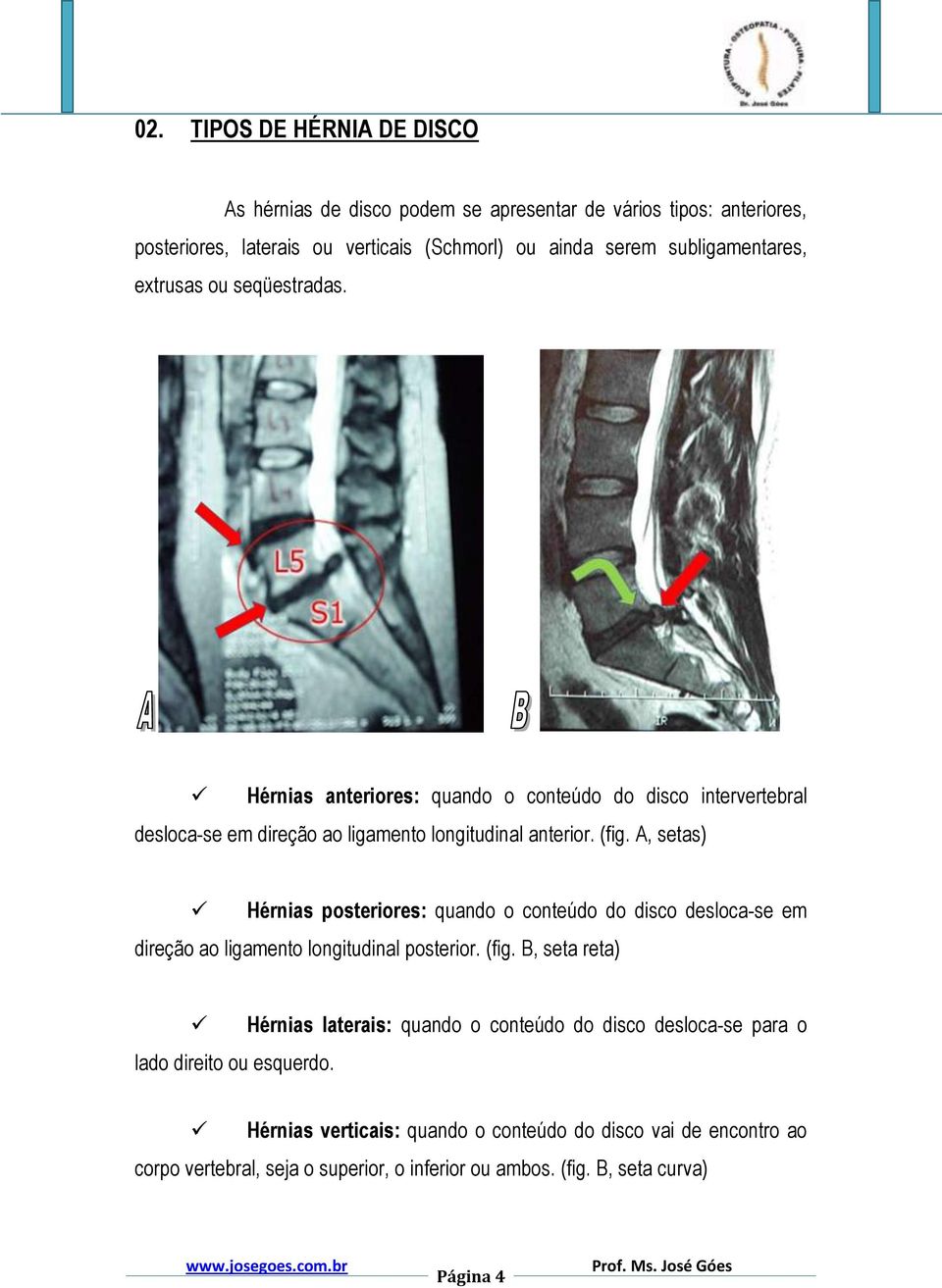 A, setas) Hérnias posteriores: quando o conteúdo do disco desloca-se em direção ao ligamento longitudinal posterior. (fig. B, seta reta) lado direito ou esquerdo.