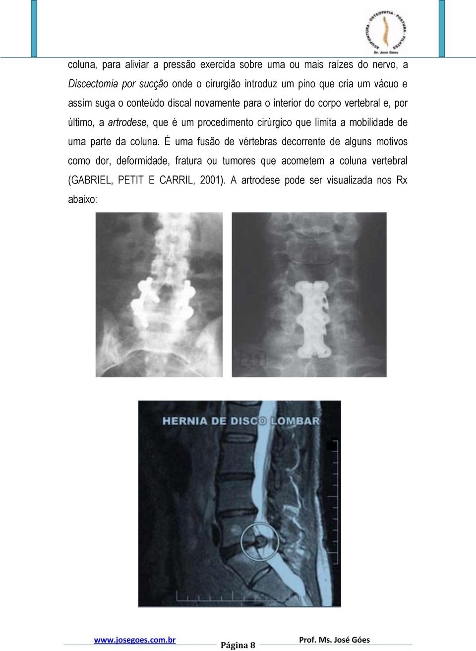 procedimento cirúrgico que limita a mobilidade de uma parte da coluna.