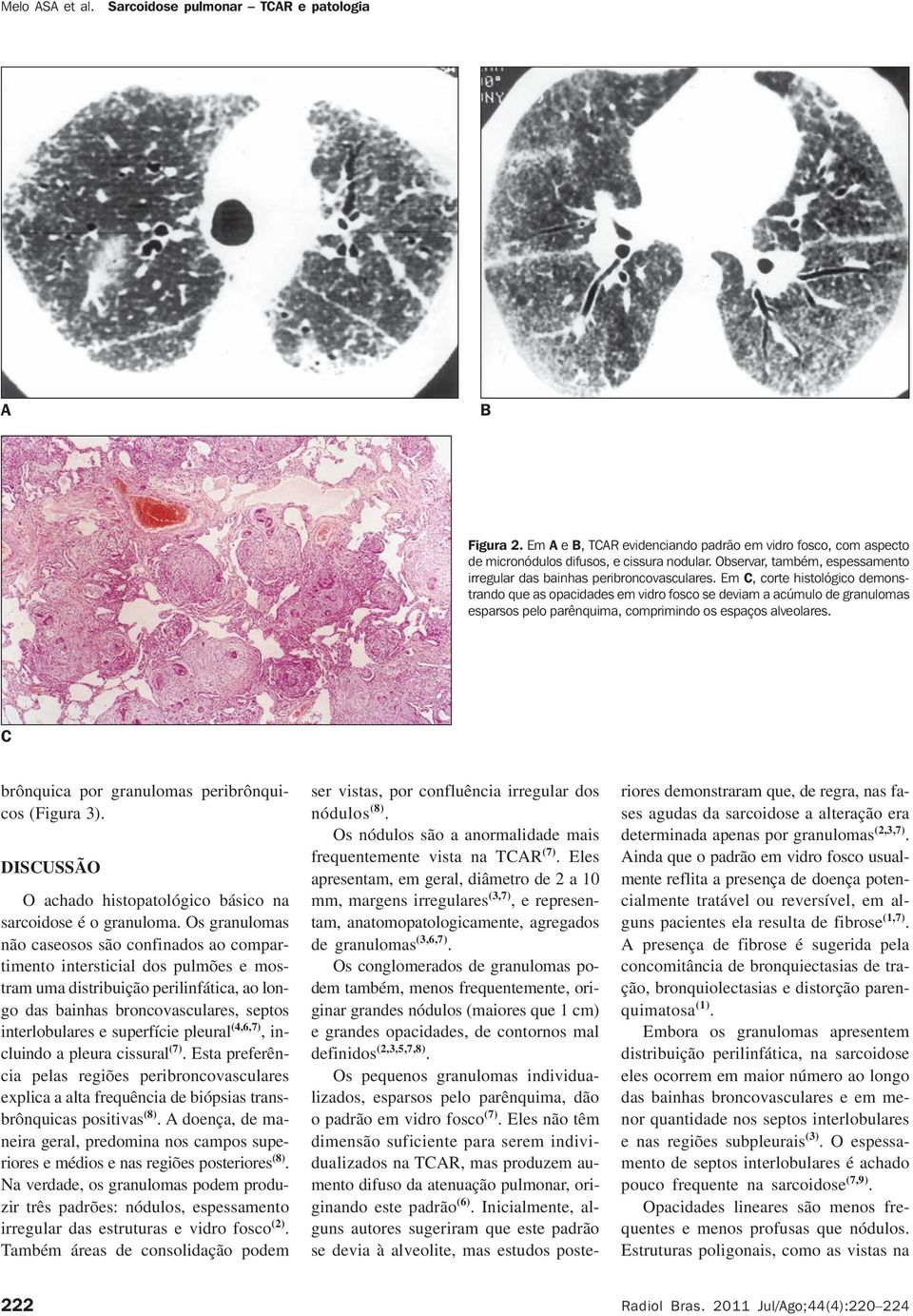 brônquica por granulomas peribrônquicos (Figura 3). DISUSSÃO O achado histopatológico básico na sarcoidose é o granuloma.